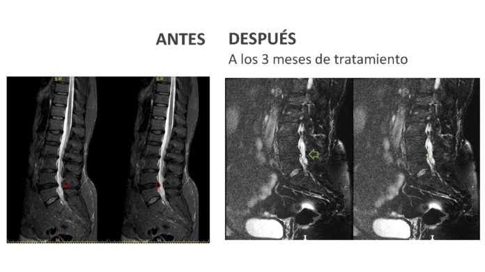 ANTES Y DESPUÉS DISCOLOSIS CON OZONO HERNIA DISCAL