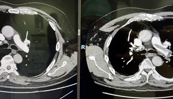 posterior y previo a tratamiento