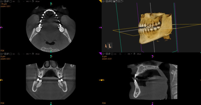 ortopantomografia-3d-hospital-quironsalud-marbella-maxilofacial